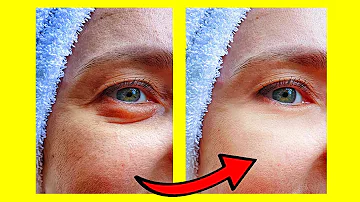 ¿Cómo eliminar las bolsas de los ojos de forma natural?