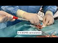 Ecmo cannulation