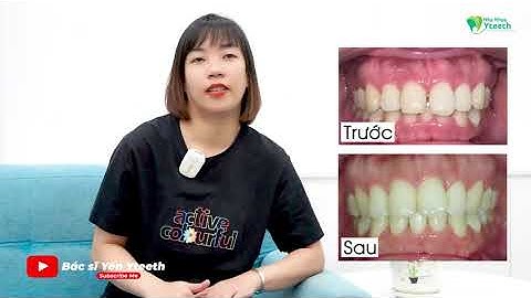 Tháo niềng răng cửa bị thưa sau 12 tháng || Bác sĩ Yến Yteeth