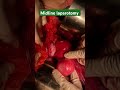 #unmarried #young #girl #with #abdominal #pain #bridetobe #gynaecologist #obstetrician  #cystectomy
