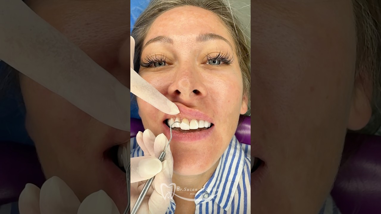 Dr Suzan dental clinic in Dubai, non shaving veneers 