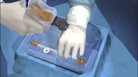 Arrow OnControl Bone Marrow Aspiration and Biopsy Patient Video