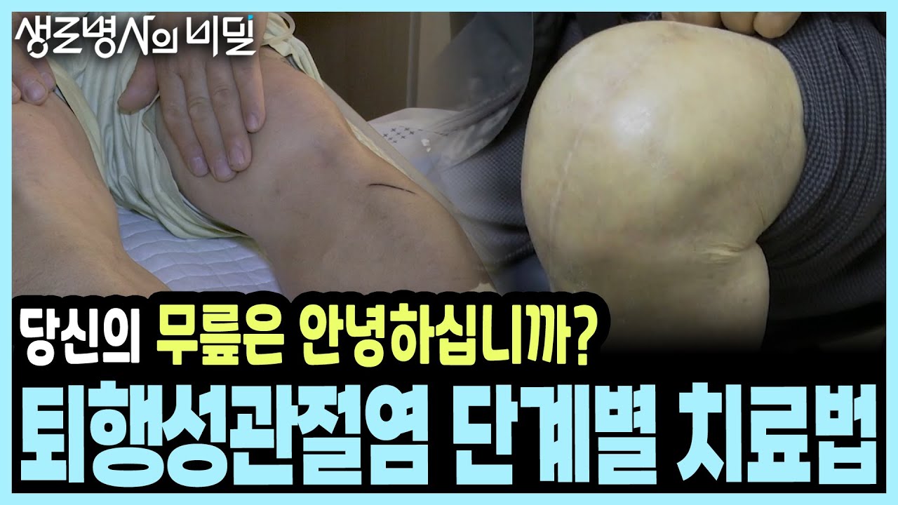 뼈와 뼈 마찰의 극심한 고통! 100세 시대 ‘걷는’ 행복을 찾기 위한 퇴행성관절염 극복하기!  I KBS 20181219 방송