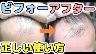 ミノキシジルの薄毛 改善効果が本当に凄かった Youtube ミノキシジルの薄毛 改善効果が本当に凄かった Youtube