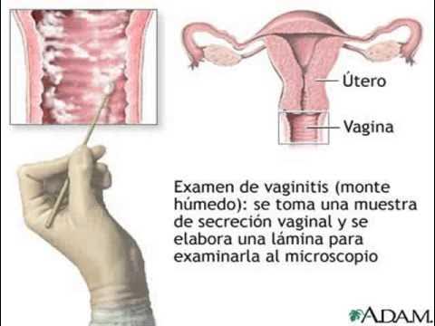 Лечение вульвит у женщин симптомы фото Como curar la vaginosis o vaginitis bacteriana - YouTube