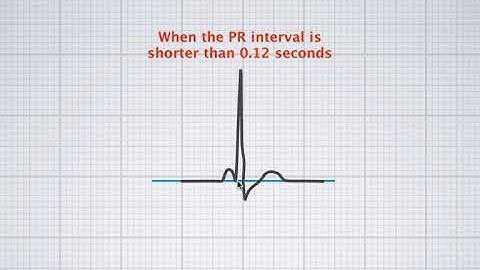 Interpreting ECG duration