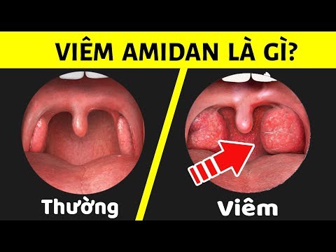 Video: Cách đánh giá và điều trị bệnh viêm họng hạt: 13 bước (có hình ảnh)