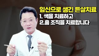 임신후 발생한 튼살 치료 두가지방법 색과 흉터 조직을 치료합니다. #임신튼살#튼살치료
