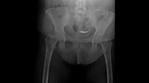 Retrospective Hysterosalpingogram (HSG) X-Ray Exam: View of Uterus and Fallopian Tubes