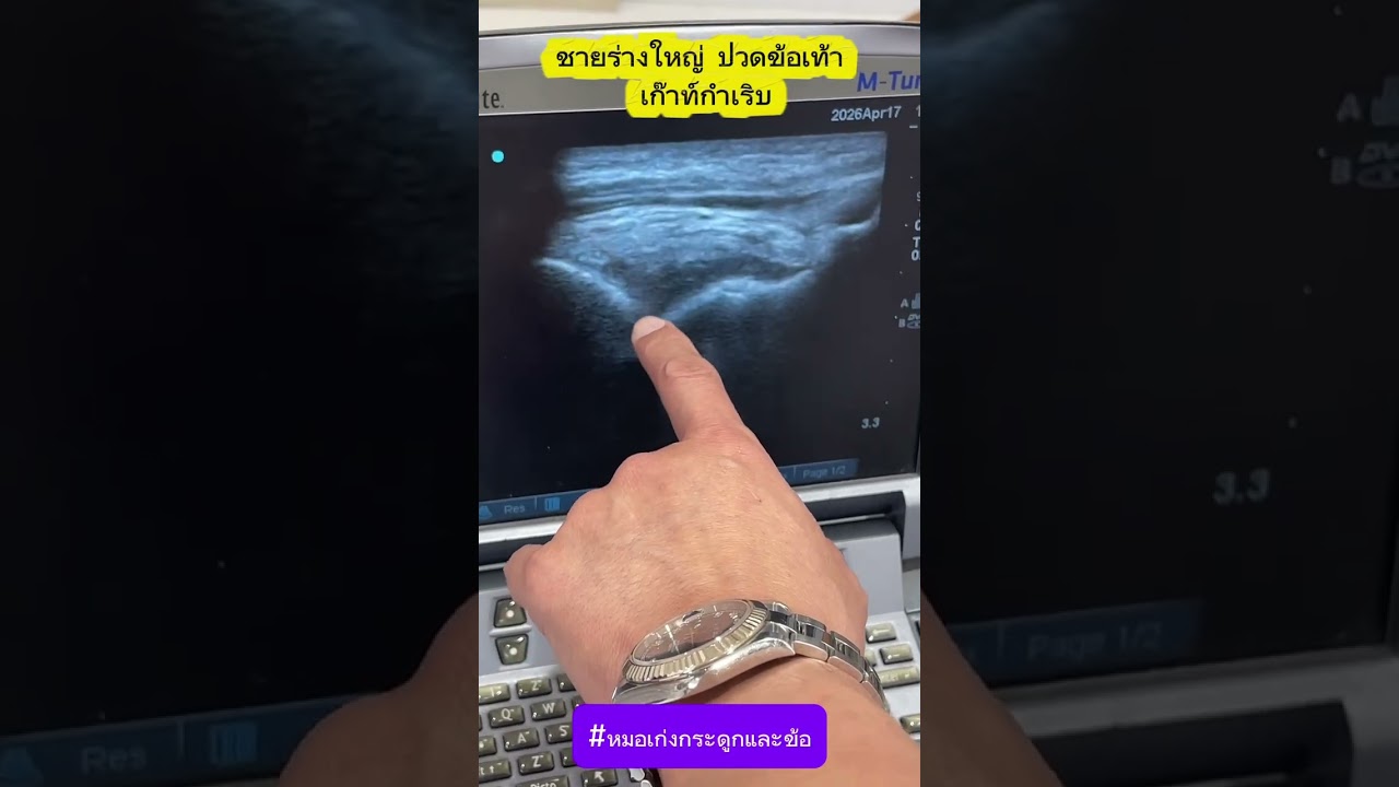 ชายร่างใหญ่ ปวดข้อเท้า เก้าท์กำเริบ