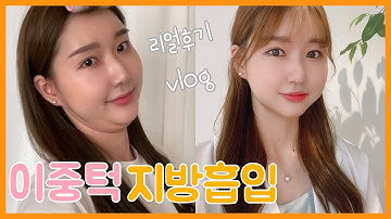 (ENG)이중턱 지방흡입 리얼후기?두턱아 잘가라~(당일부터 이주차까지)Double Chin Liposuction Real Review,korea plastic surgery