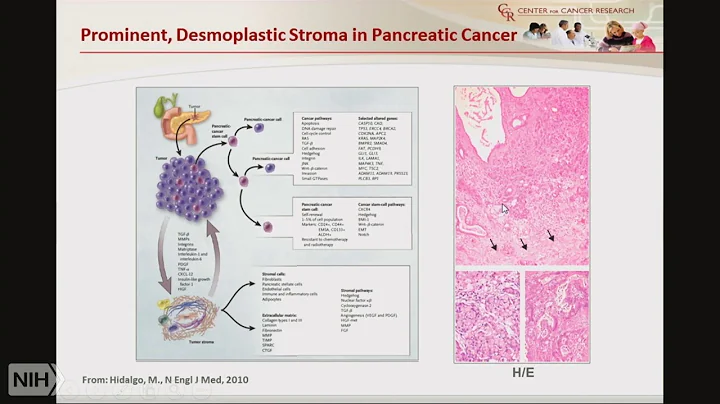 TRACO 2017: Pancreatic cancer and Nanotechnology