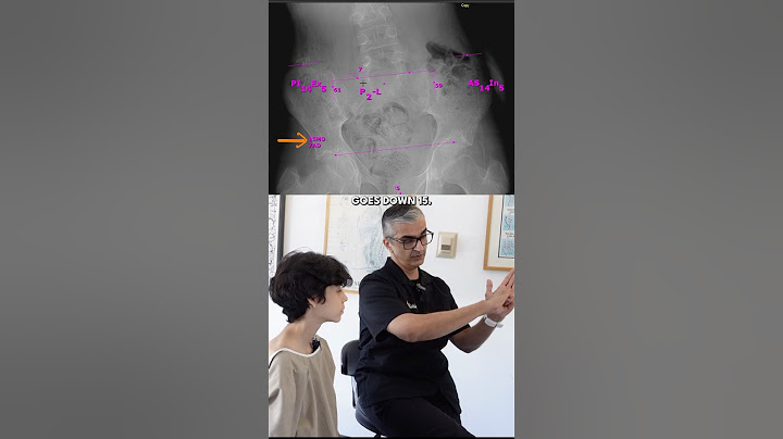 9 Years Limping and SEVERE Back Pain | Coccyx & Pelvis Adjustment #shorts