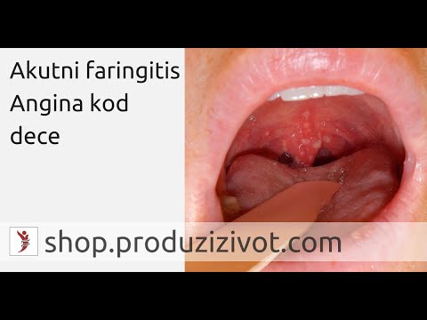 Akutni faringitis • Angina kod dece