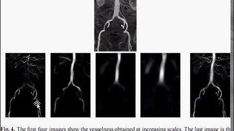 extraction of tube-like structures in 3D images
