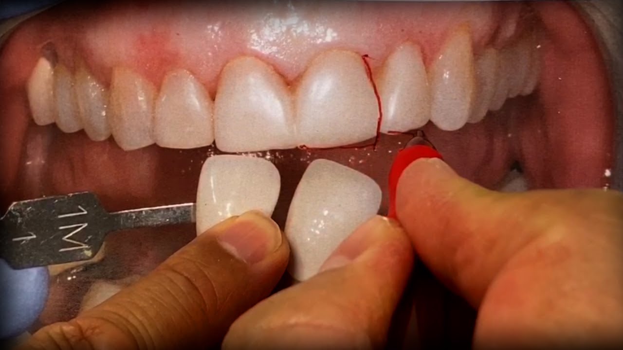 How to Make Beautiful Ceramic Veneers - YouTube