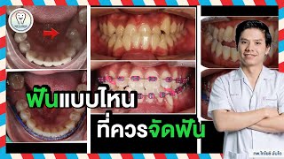ลักษณะฟันแบบไหนที่ควรจัดฟัน #จัดฟัน #จัดฟันครั้งแรก #bracing #หมอชิ screenshot 2