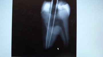 Endodontic Shift Shot Assistance