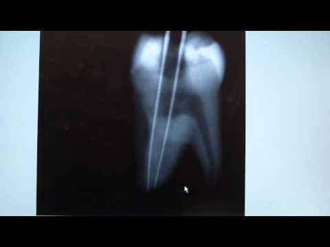 Endodontic Shift Shot Assistance