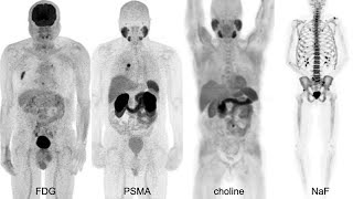 PSMA PET and Functional Imaging - 2021 Prostate Cancer Patient Conference screenshot 3