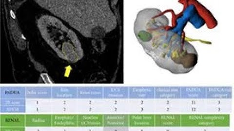 3D virtual imaging of renal tumours: a new tool to improve the accuracy of nephrometry scores
