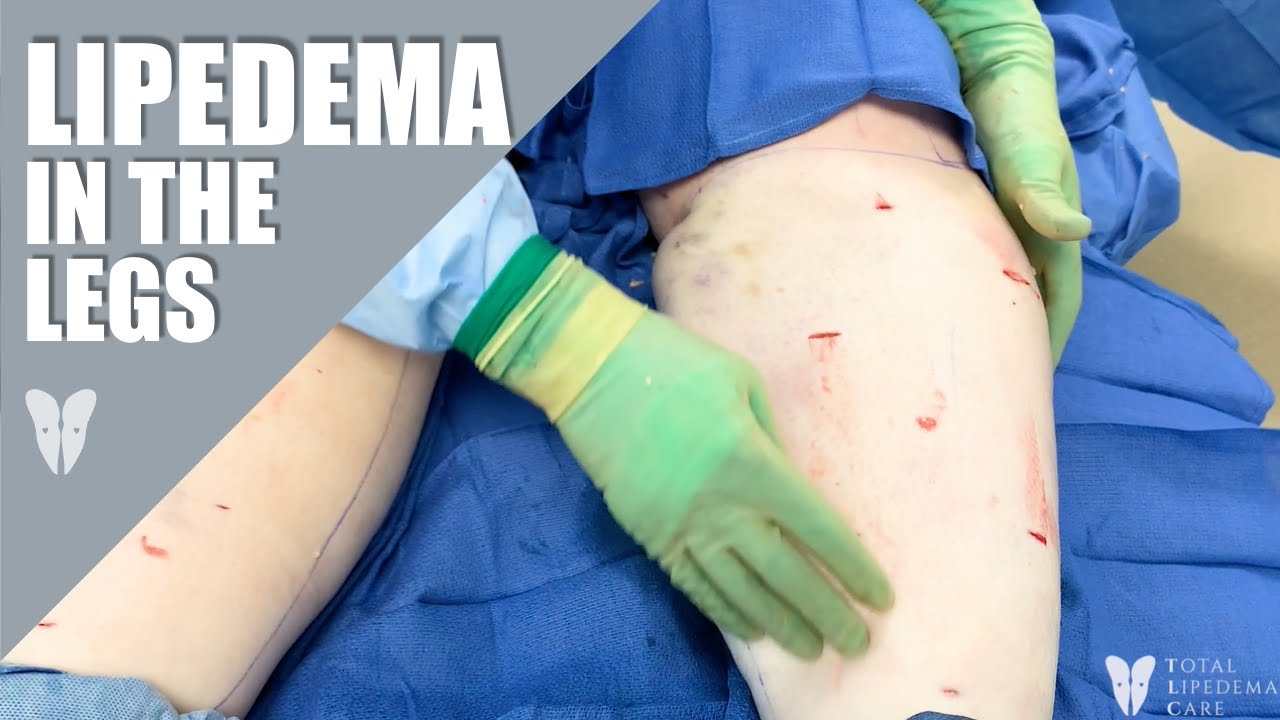 Lipedema - Island Medical (Mauritius) Ltd Academy