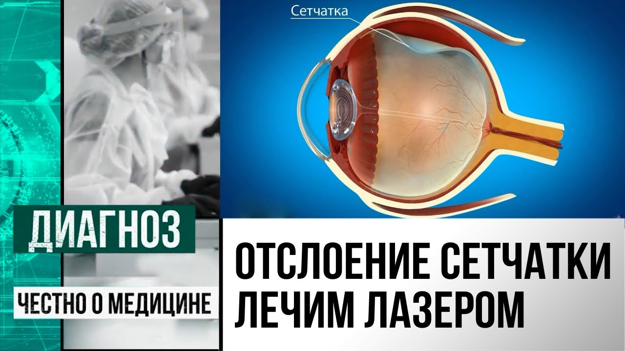 Невидимая опасность: что такое периферическая дистрофия сетчатки ...