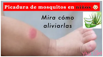 ¿Ayuda el esmalte de uñas con las picaduras de mosquito?