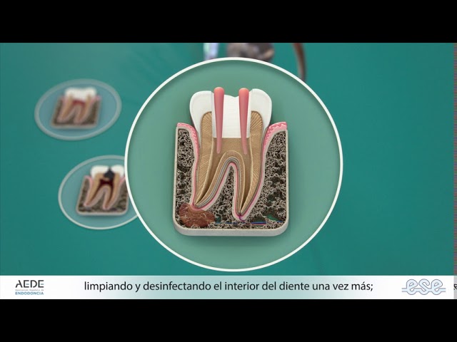 Endodontic Treatments - Spanish version