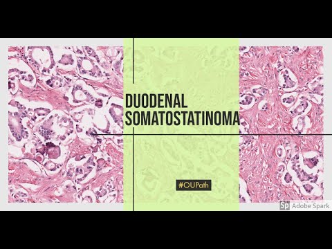 Video: Somatostatinomas: Årsager, Behandling Og Symptomer