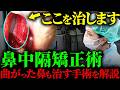 【閲覧注意】日帰りでできる鼻中隔矯正術の手術を徹底解説！#耳鼻科 #手術 #鼻づまり