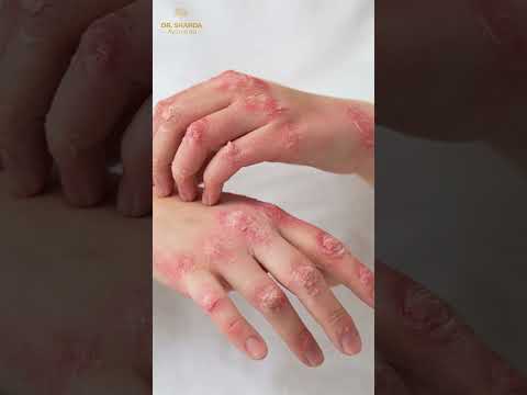 Uncovering The Secret To Psoriasis Relief Psoriasis Treatment Tips Shorts