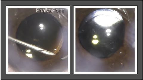 A simple way to perform surgical iridectomy with a 26G needle and a Sinskey
