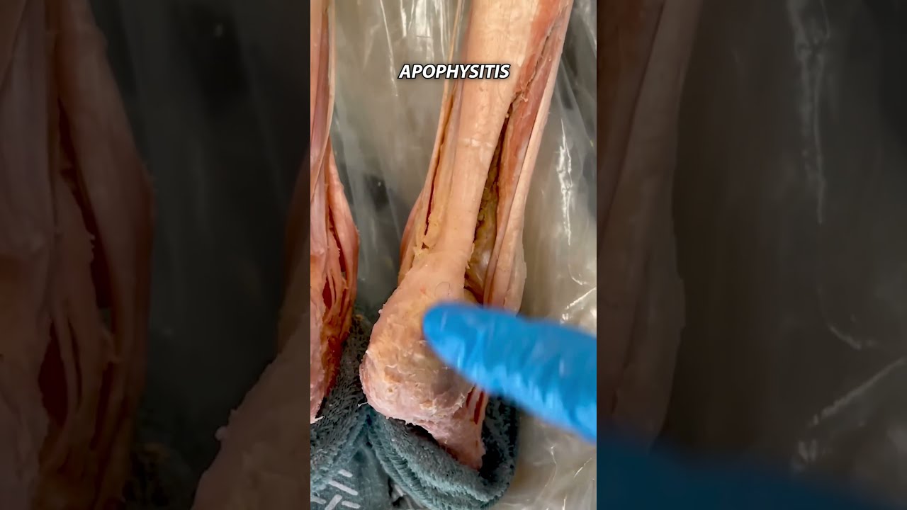 Top Cause Kid Limping With Heel Pain Shorts
