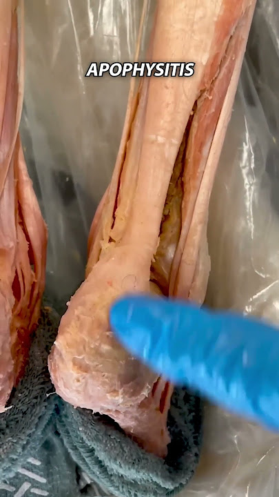 Top Cause: Kid Limping with Heel Pain? #shorts