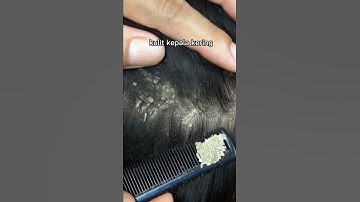 penyebab ketombe pada rambut!