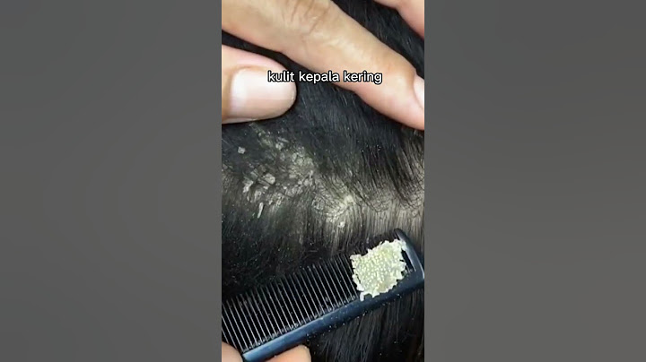 penyebab ketombe pada rambut!