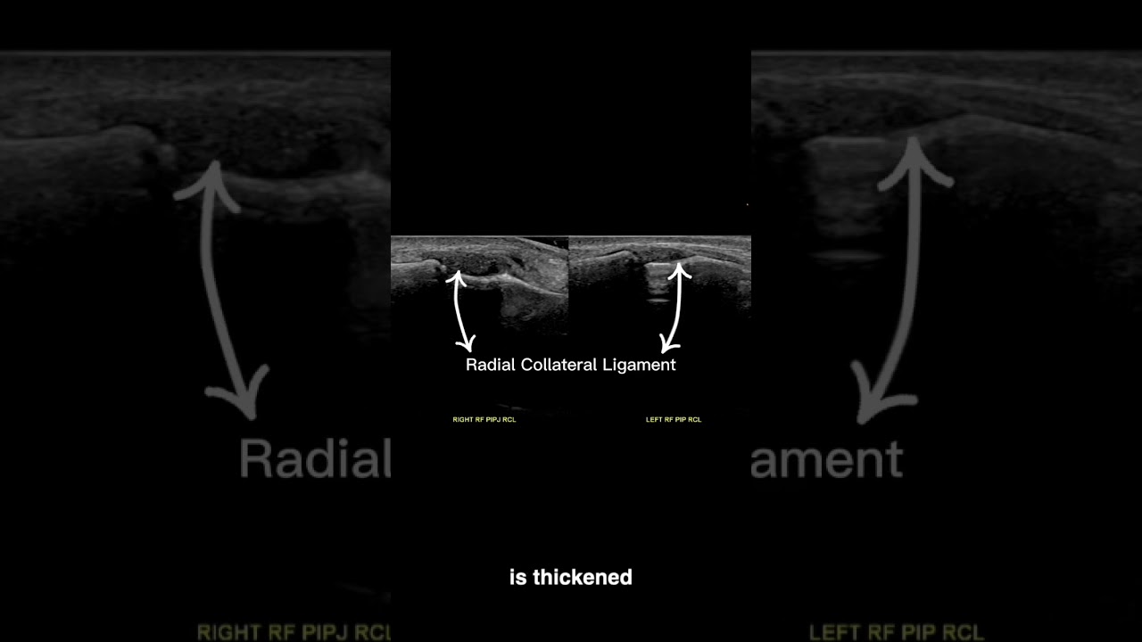 Ultrasound Guided Interventions: Cases (Radial Collateral Ligament Injury) 