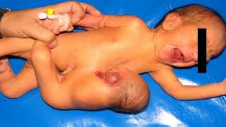 El Gemelo Parasito Fetus In Fetu