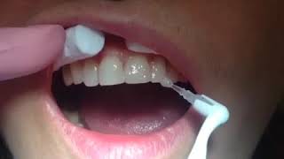 Почему чернеют молочные зубы у ребенка?