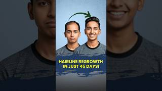 Receding hairline 45 din me kaise roken, regrowth kaise karayen ? Hair fall #WaidonAI #viral #shorts