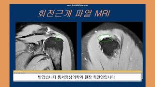 회전근개 파열MRI