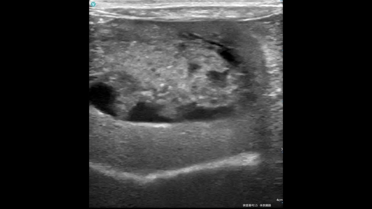 Gallbladder mucocele, Pocket size VS Stationary highend system, echo