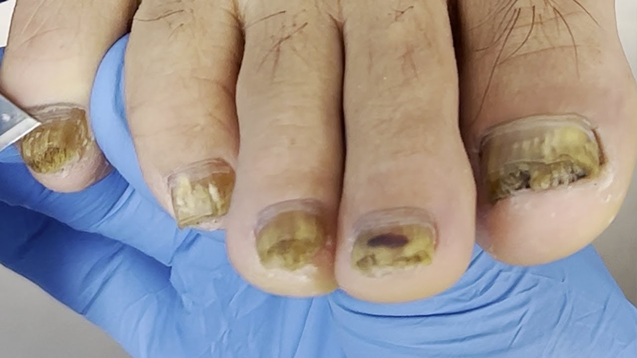 Nail fungus is contagious! Trim 5 toenails【Xue Yidao】 YouTube