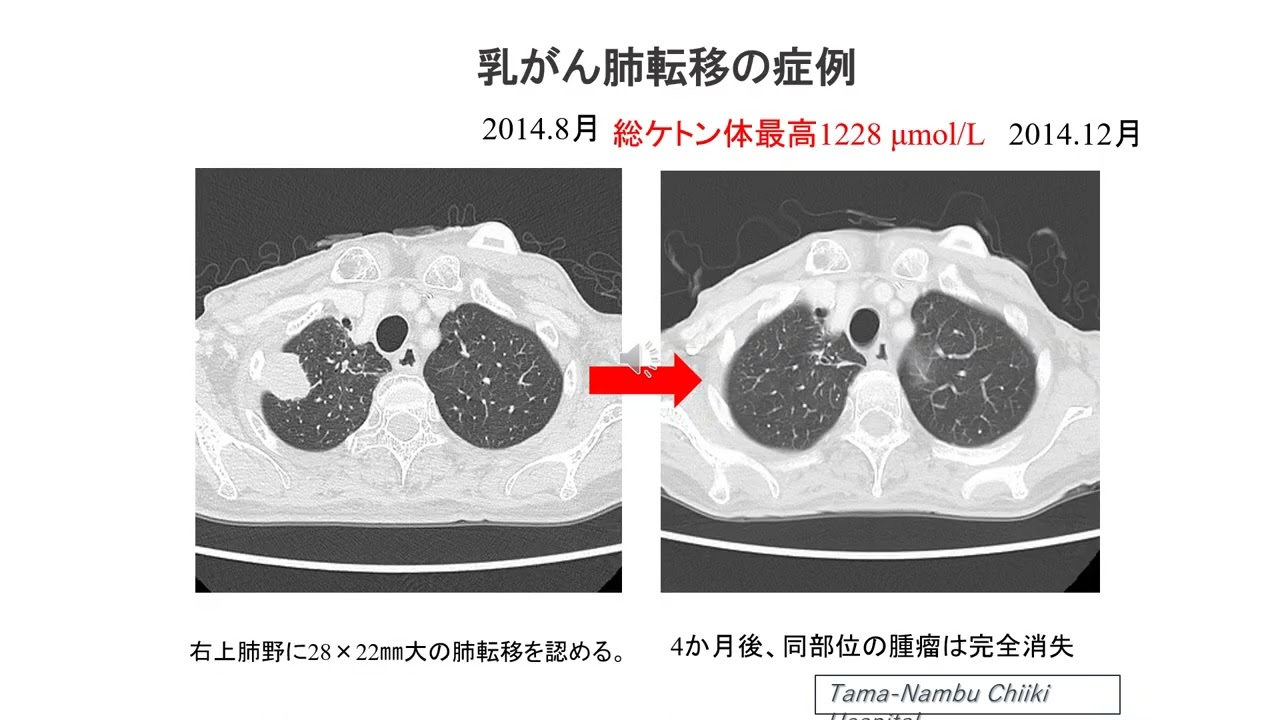 がん免疫栄養ケトン食療法 | 医療法人杉原クリニック