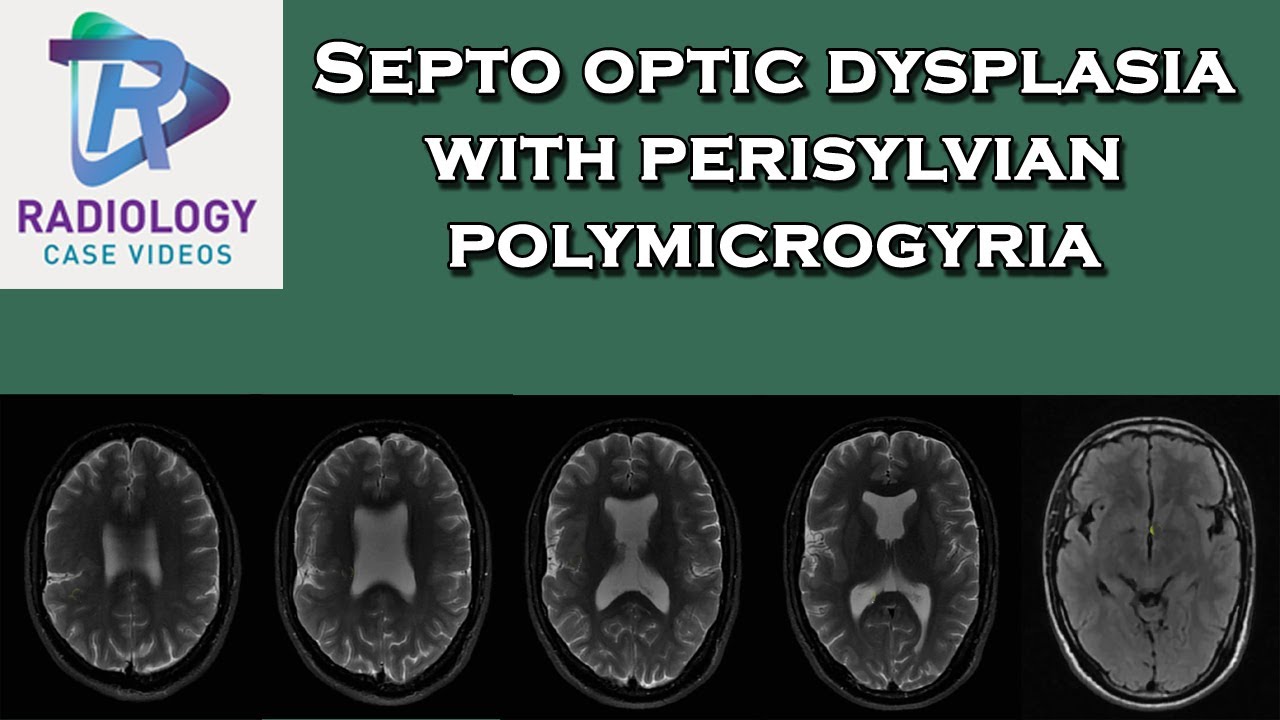 Septo optic dysplasia with perisylvian polymicrogyria