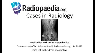 Neobladder with vesicoureteral reflux (Radiopaedia.org) Cases in Radiology