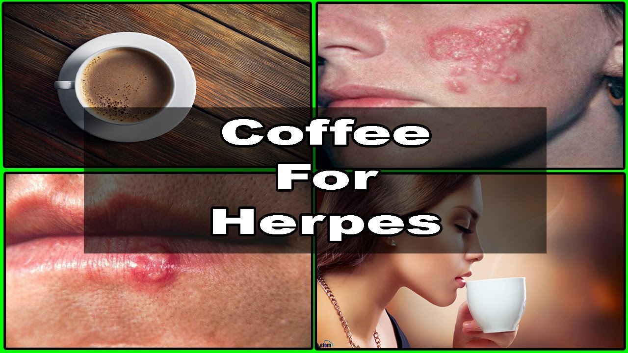 This Is How Coffee Is Interconnected WIth Your Herpes Outbreaks. YouTube