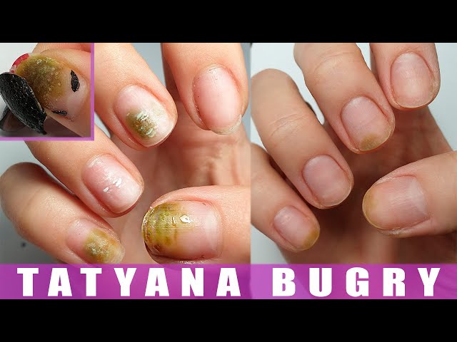 Fungal Nails - THE FOOT FIXERS