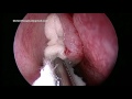 Csf leak repair 2   packing the middle meatus